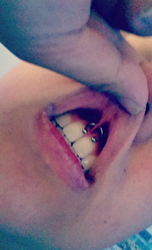 Smiley piercing